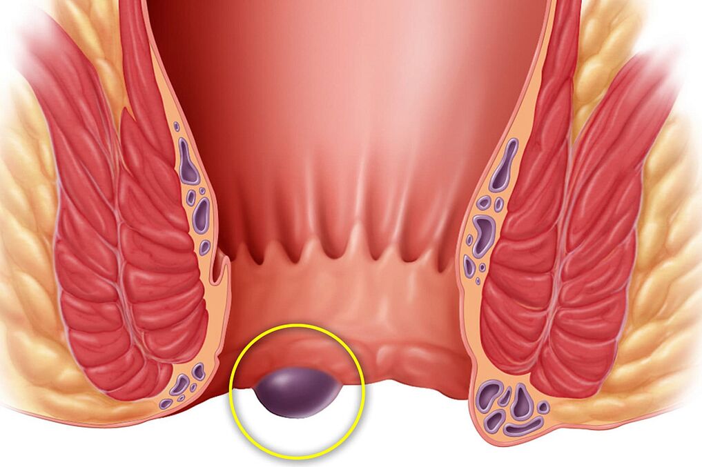 hemoroid